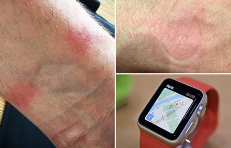 Can Smartwatches Cause Nerve Damage?